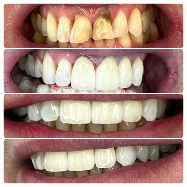 metamorfozy_usmiechu_denis_clinic_15